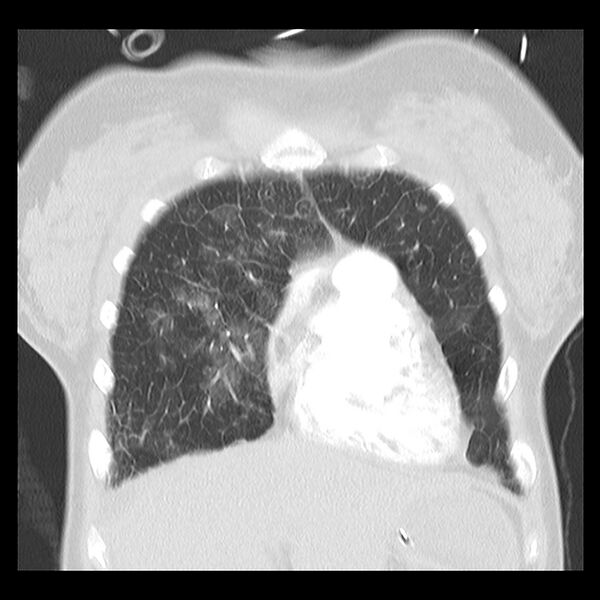 File:Acute pulmonary edema on CT (Radiopaedia 33582-34672 Coronal lung window 7).jpg