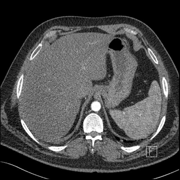 File:Acute pulmonary embolism with pulmonary infarct (Radiopaedia 73062-83768 Axial C+ CTPA 73).jpg