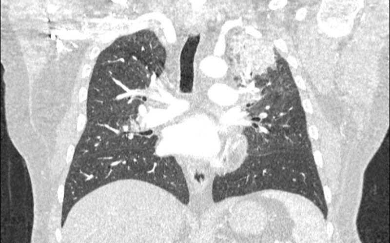 File:Acute pulmonary embolism with pulmonary infarcts (Radiopaedia 77688-89908 Coronal lung window 51).jpg