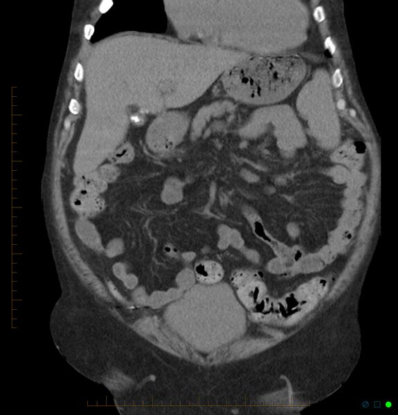 File:Acute renal failure post IV contrast injection- CT findings (Radiopaedia 47815-52557 Coronal non-contrast 12).jpg