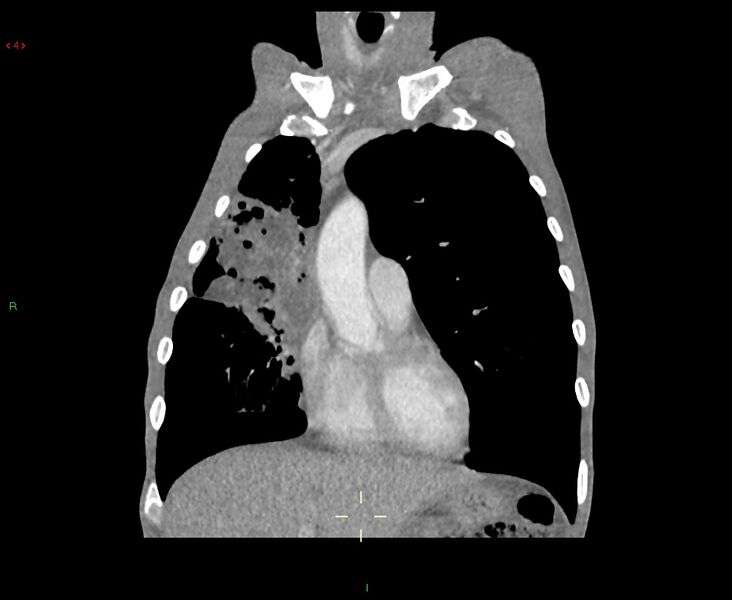 File:Acute right lung abscess (Radiopaedia 34806-36258 Coronal C+ arterial phase 40).jpg