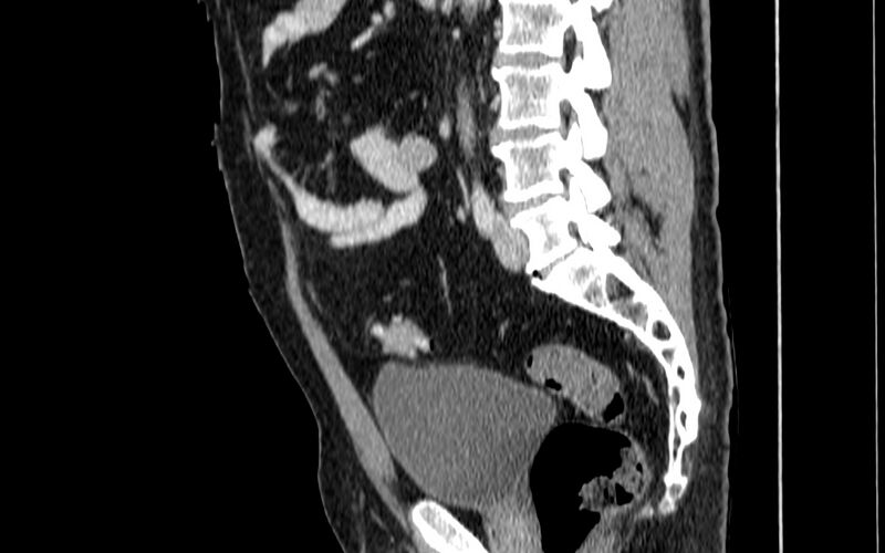 File:Acute sigmoid colon diverticulitis (Radiopaedia 55507-61976 Sagittal C+ portal venous phase 12).jpg