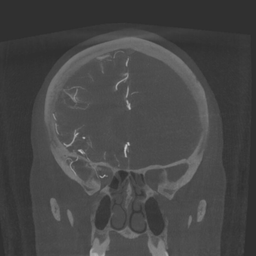 Acute subarachnoid hemorrhage and accessory anterior cerebral artery (Radiopaedia 69231-79010 Coronal arterial - MIP 32).jpg