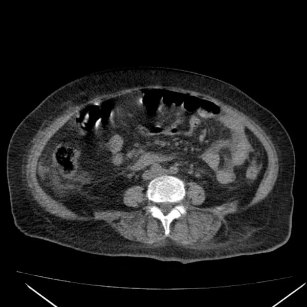 File:Acute tubular necrosis (Radiopaedia 28077-28334 Axial non-contrast 41).jpg