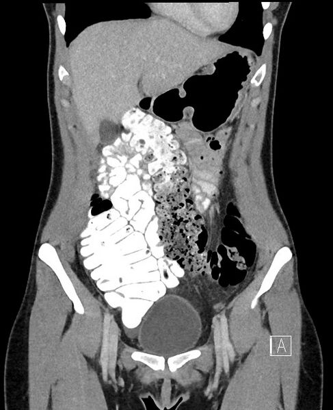 File:Acute uncomplicated appendicitis (Radiopaedia 61374-69304 Coronal C+ portal venous phase 27).jpg