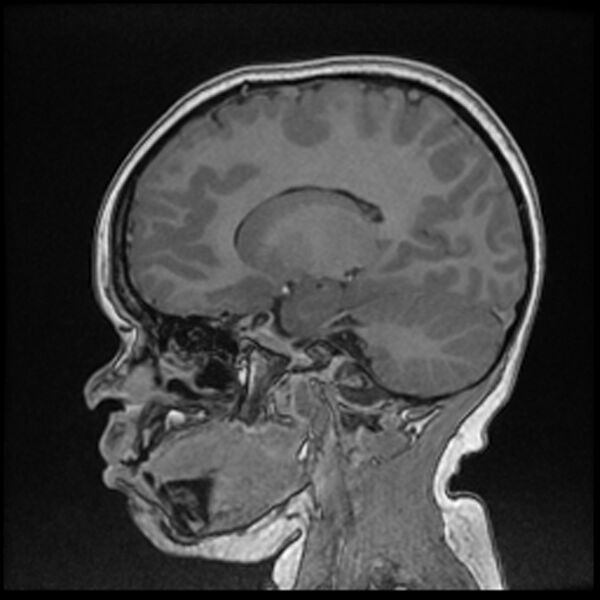 File:Adamantinomatous craniopharyngioma (Radiopaedia 77407-89529 Sagittal T1 C+ 53).jpg