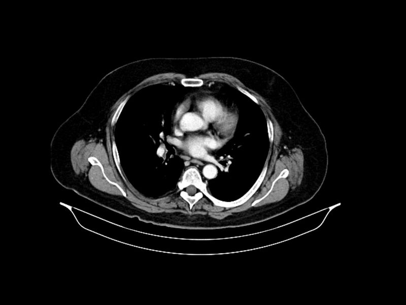 File:Adenocarcinoma of pancreas with hepatic metastasis (Radiopaedia 64332-73122 Axial C+ portal venous phase 4).jpg