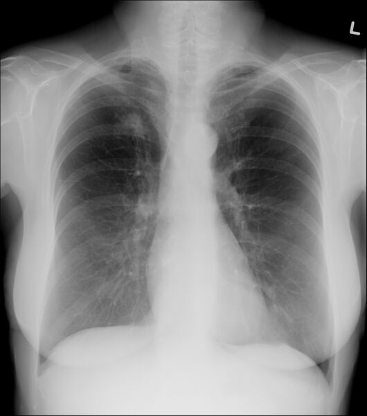File:Adenocarcinoma of the lung (Radiopaedia 41015-43754 Frontal 1).jpg
