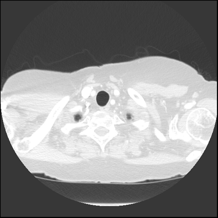 Adenocarcinoma of the lung (Radiopaedia 41015-43755 Axial lung window 7).jpg