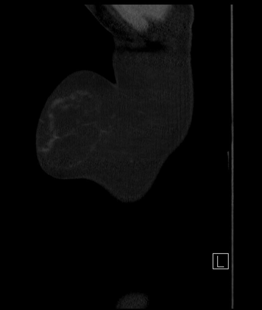 Adenocarcinoma of the lung (Radiopaedia 44205-47803 Sagittal C+ portal venous phase 60).jpg