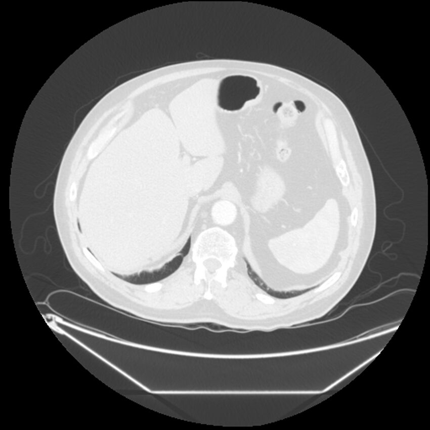 Adenocarcinoma of the lung (Radiopaedia 44876-48759 Axial lung window 75).jpg