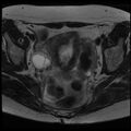 Adenoma malignum of the cervix (Radiopaedia 24460-24765 C 9).jpg