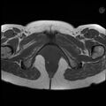 Adenoma malignum of the cervix (Radiopaedia 24460-24765 T1 19).jpg