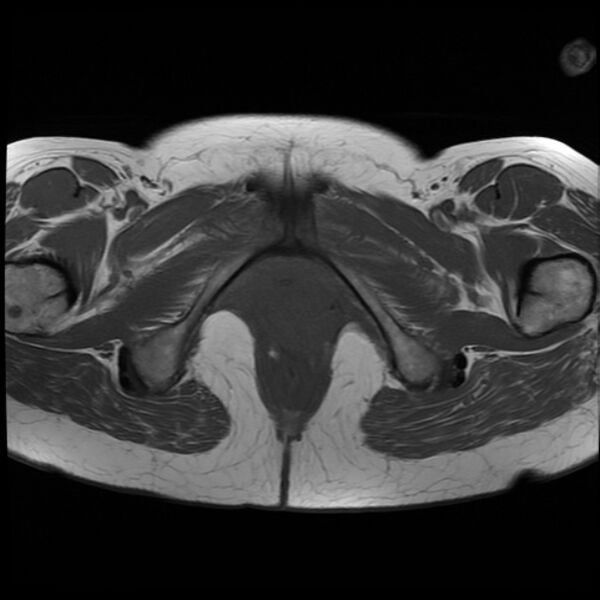 File:Adenoma malignum of the cervix (Radiopaedia 24460-24765 T1 19).jpg
