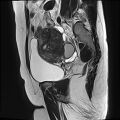 Adenomyosis - ovarian endometriomas (Radiopaedia 67031-76350 Sagittal T2 18).jpg