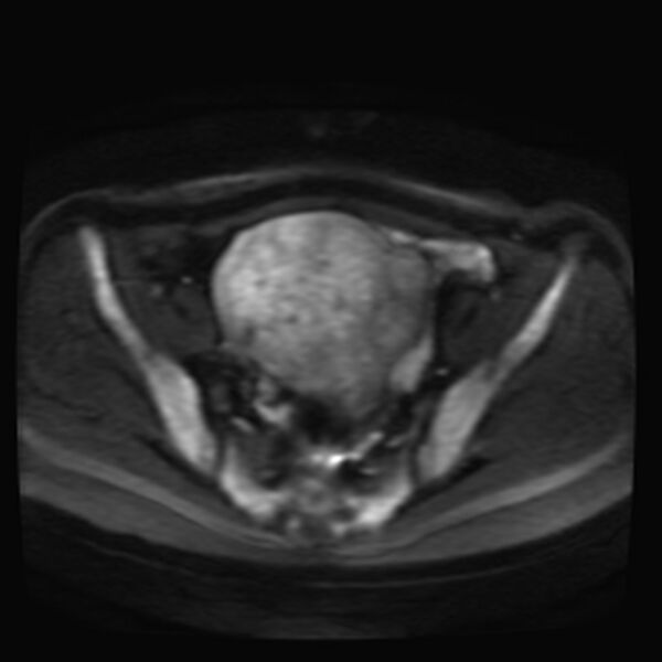 File:Adenomyosis on MRI (Radiopaedia 29328-29780 Axial DWI 5).jpg