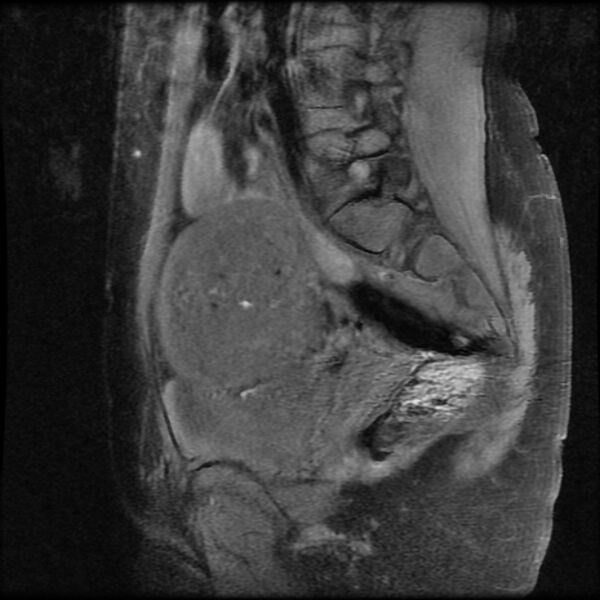 File:Adenomyosis on MRI (Radiopaedia 29328-29780 Sagittal T1 fat sat 5).jpg