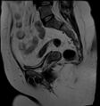 Adnexal multilocular cyst (O-RADS US 3- O-RADS MRI 3) (Radiopaedia 87426-103754 Sagittal T2 10).jpg