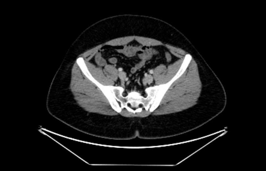 Adrenocortical carcinoma (Radiopaedia 80134-93438 Axial C+ portal venous phase 102).jpg