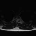 Aggressive vertebral hemangioma (Radiopaedia 39937-42404 Axial T2 35).png