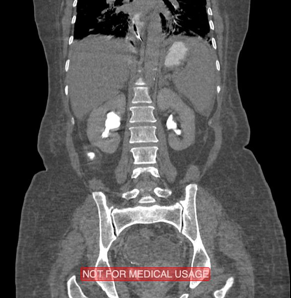 File:Amoebic enterocolitis with liver abscess (Radiopaedia 35100-36609 B 135).jpg
