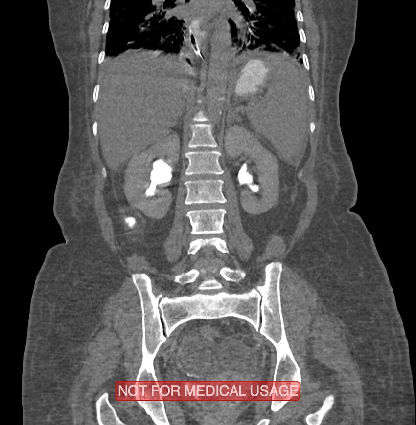 Amoebic enterocolitis with liver abscess (Radiopaedia 35100-36609 B 135).jpg