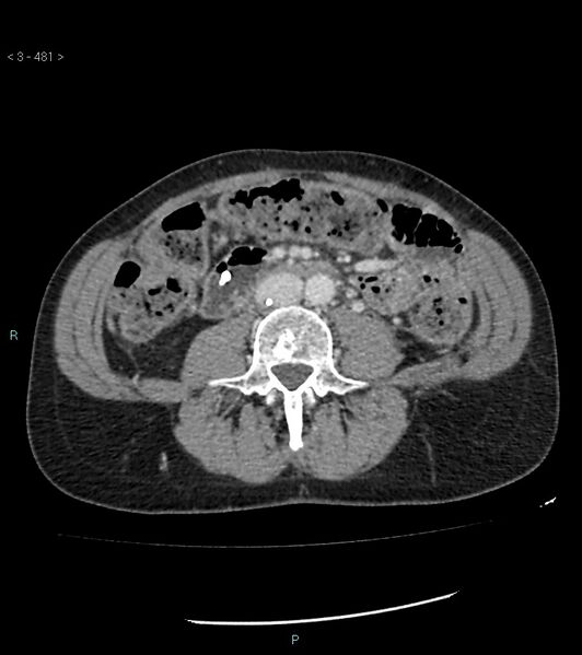 File:Ampulla of Vater metastasis (Radiopaedia 27820-28069 A 119).jpg