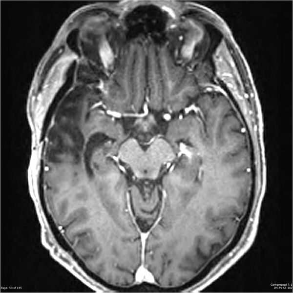 File:Anaplastic meningioma with recurrence (Radiopaedia 34452-35788 Axial T1 C+ 59).jpg