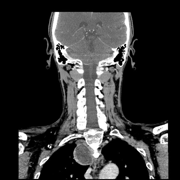 File:Anaplastic thyroid carcinoma (Radiopaedia 79087-92034 A 82).jpg