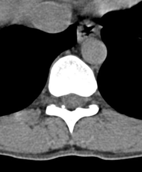 File:Aneurysmal bone cyst T11 (Radiopaedia 29294-29721 Axial non-contrast 35).jpg