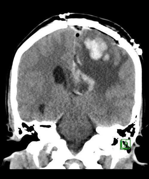 File:Angiomatous meningioma (Radiopaedia 79459-92578 Coronal non-contrast 22).jpg