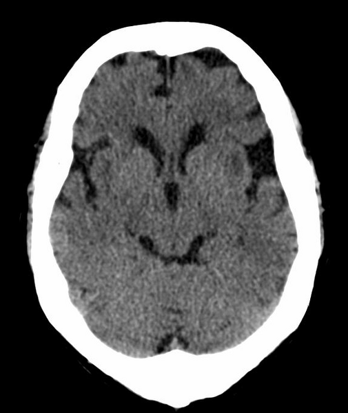 File:Anomalous intracranial venous drainage (Radiopaedia 28161-28418 Axial 29).png