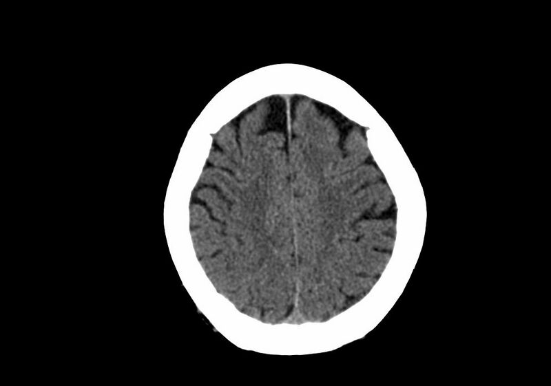 File:Anomalous intracranial venous drainage (Radiopaedia 28161-28418 Axial non-contrast 35).jpg