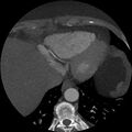 Anomalous origin of left circumflex artery from right coronary sinus (Radiopaedia 72563-83117 A 9).jpg
