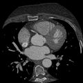Anomalous origin of left circumflex artery from right coronary sinus (Radiopaedia 72563-83117 B 59).jpg