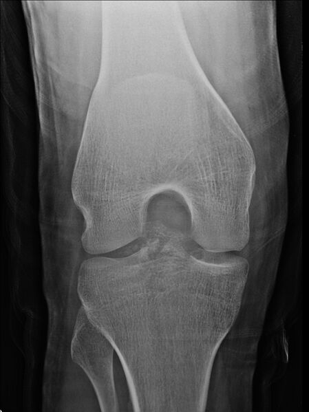 File:Anterior cruciate ligament bony avulsion (Radiopaedia 12579-12800 C 1).jpg