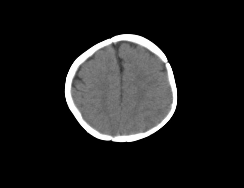 File:Anterior plagiocephaly (Radiopaedia 71836-82273 Axial non-contrast 16).jpg