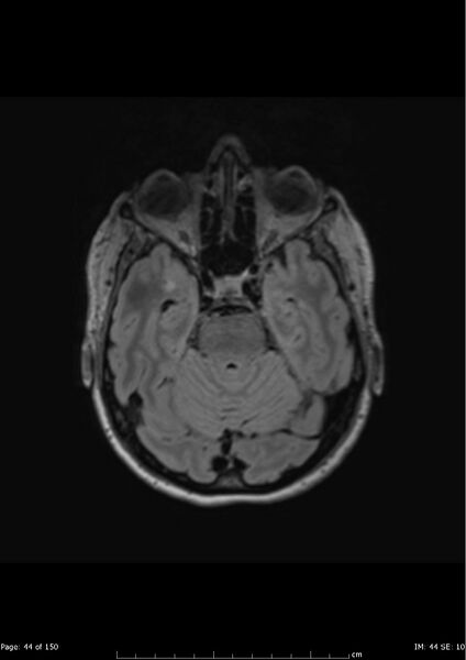 File:Anterior temporal lobe perivascular space (Radiopaedia 40946-43650 Axial FLAIR 5).jpg