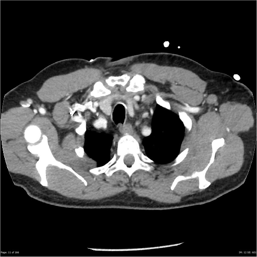 Aortic dissection- Stanford A (Radiopaedia 37759-39664 A 2).jpg