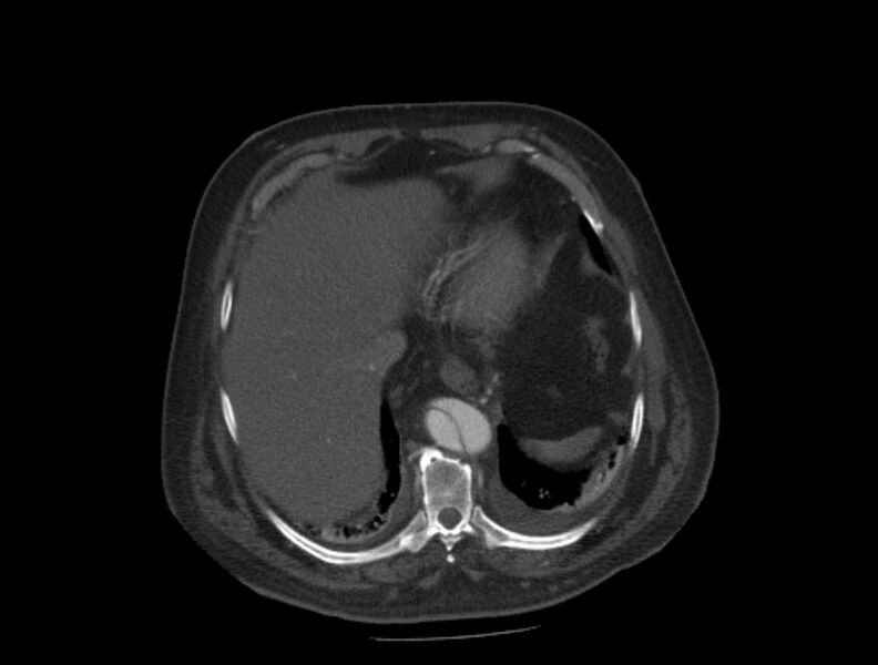 File:Aortic dissection (Radiopaedia 28802-29105 A 34).jpg