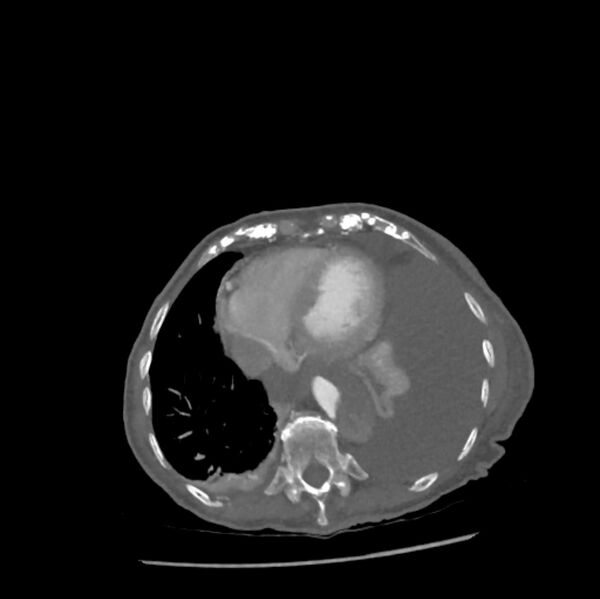 File:Aortic dissection (Radiopaedia 68763-78691 A 42).jpeg