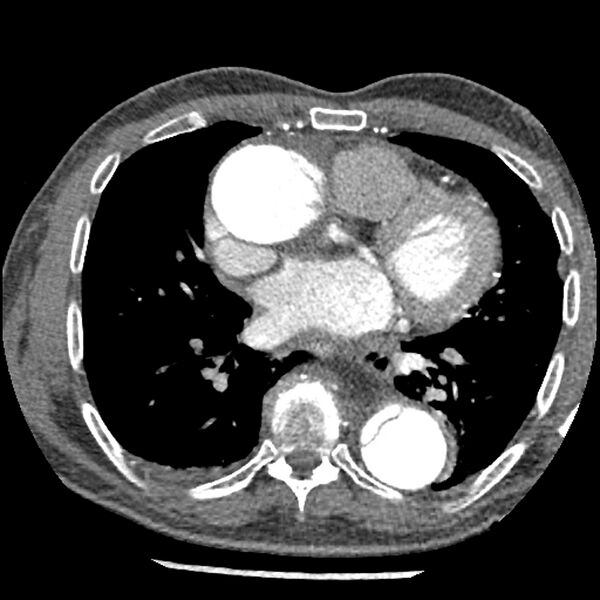 File:Aortic dissection - DeBakey Type I-Stanford A (Radiopaedia 79863-93115 A 22).jpg
