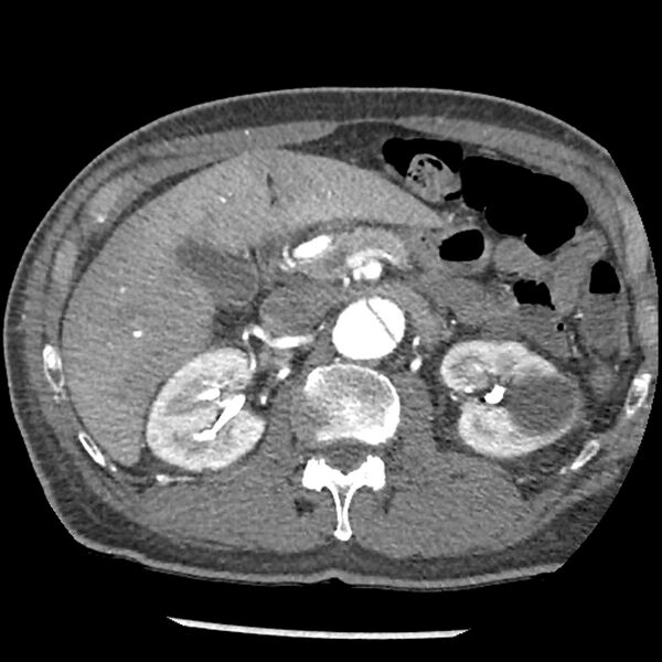 File:Aortic dissection - DeBakey Type I-Stanford A (Radiopaedia 79863-93115 A 46).jpg
