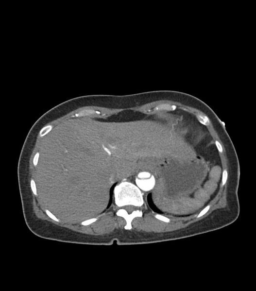 File:Aortic dissection with renal ischemia (Radiopaedia 76573-88338 A 56).jpg