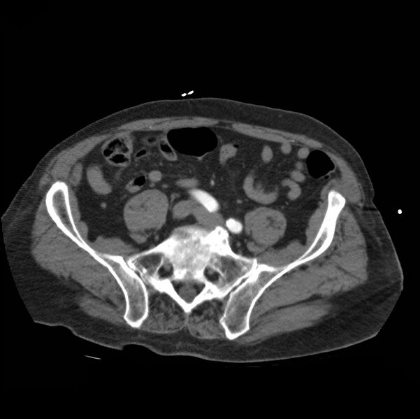 File:Aortic dissection with rupture into pericardium (Radiopaedia 12384-12647 A 75).jpg