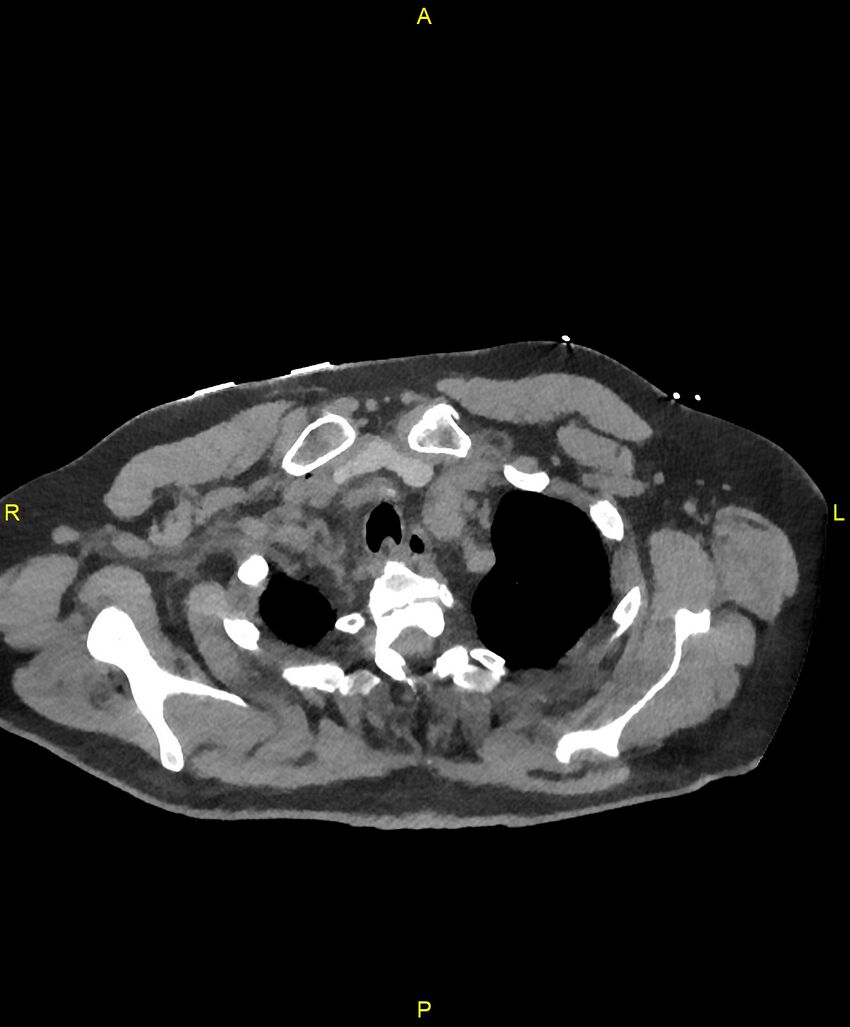 Aortic rupture (Radiopaedia 88822-105594 Axial non-contrast 20).jpg