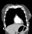 Aortic valve non-coronary cusp thrombus (Radiopaedia 55661-62189 C 17).png