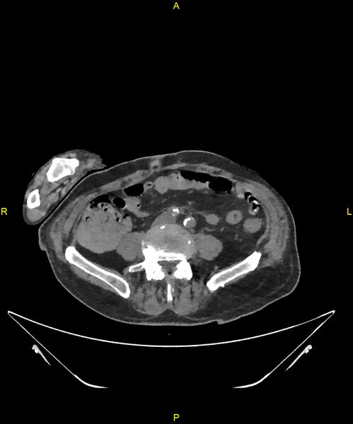 File:Aortoenteric fistula (Radiopaedia 84308-99603 Axial non-contrast 238).jpg