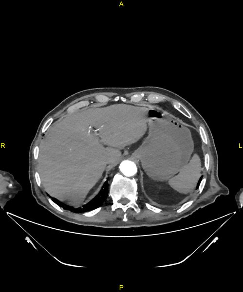 File:Aortoenteric fistula (Radiopaedia 84308-99603 B 44).jpg