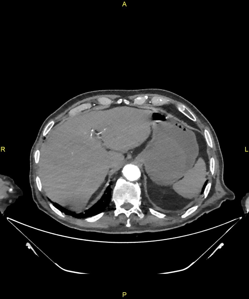 Aortoenteric fistula (Radiopaedia 84308-99603 B 44).jpg